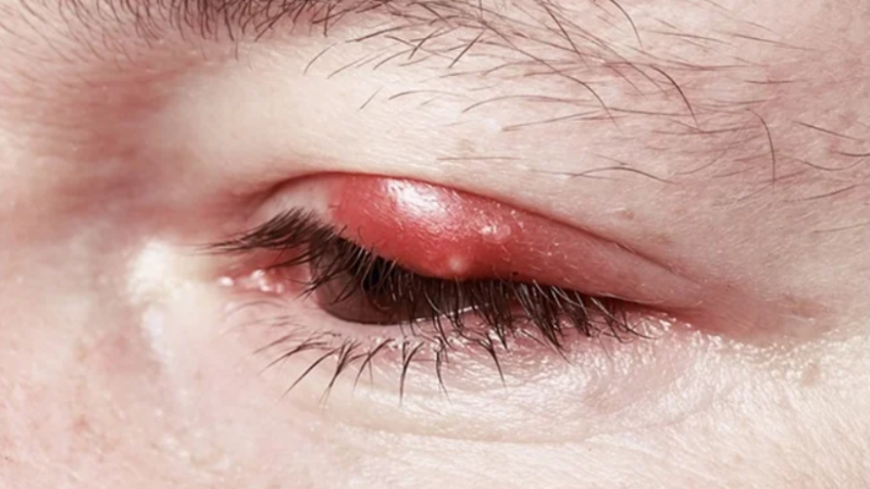 Types of blepharitis and causes